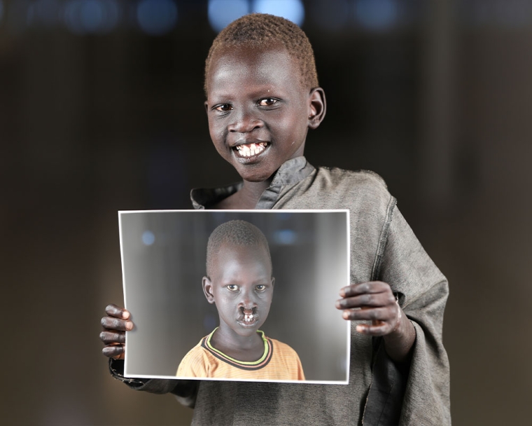 Machiek Makur smiling and holding a picture of himself before cleft surgery