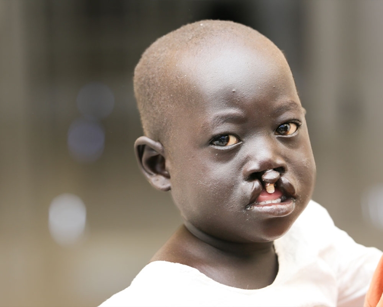 Ngor before cleft surgery
