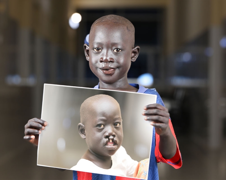 Ngor smiling and holding a picture of himself before cleft surgery