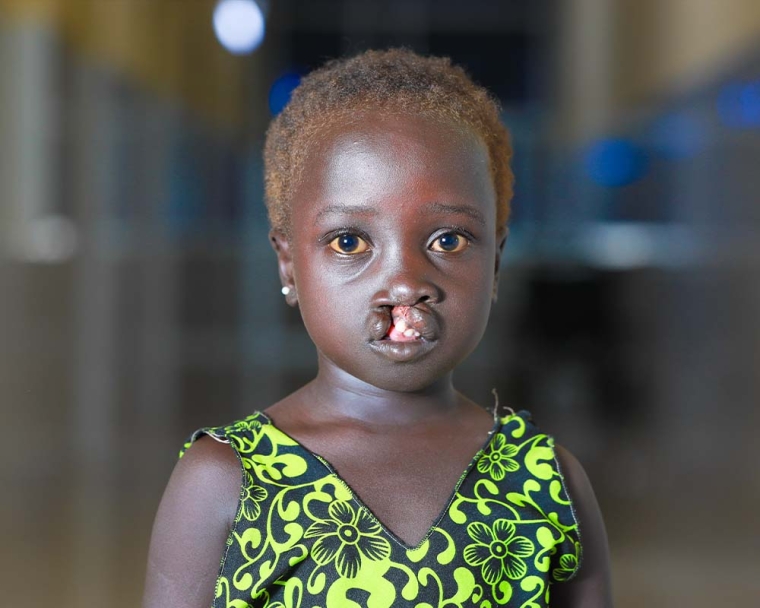 Nyanchiek before cleft surgery