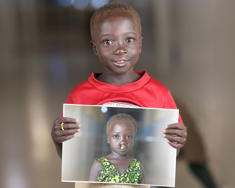 Nyanchiek smiling and holding a picture of herself before cleft surgery
