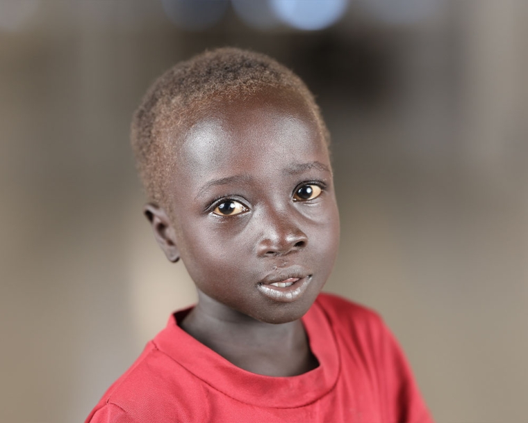 Nyanchiek smiling after cleft surgery