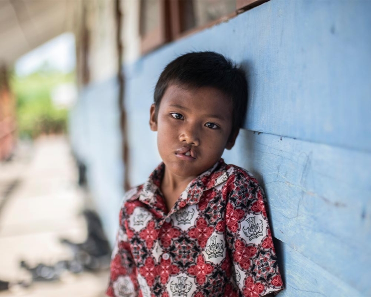 Rajib before cleft surgery