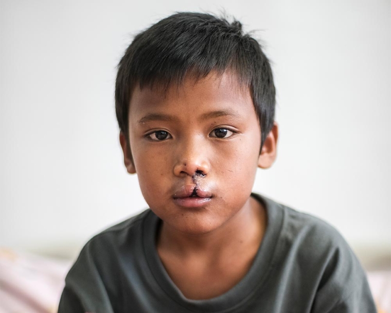Rajib after cleft surgery