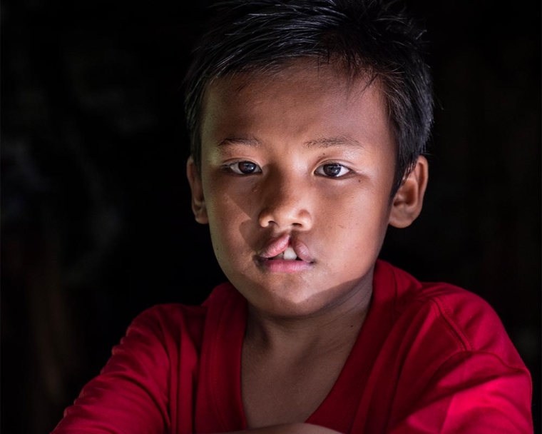 Rajib before cleft surgery