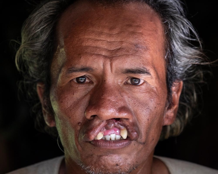 Alim before cleft surgery