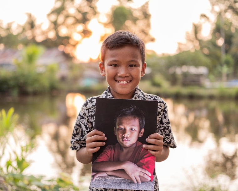 Rajib smiling and holding a photo of himself before cleft surgery