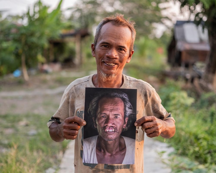 Alim smiling and holding a photo of himself before cleft surgery