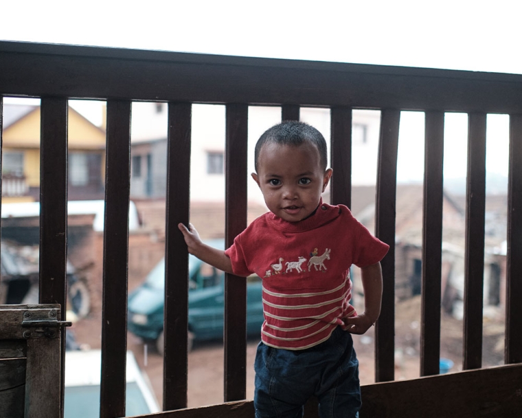 Eden after cleft surgery