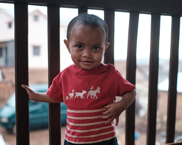 Eden after cleft surgery
