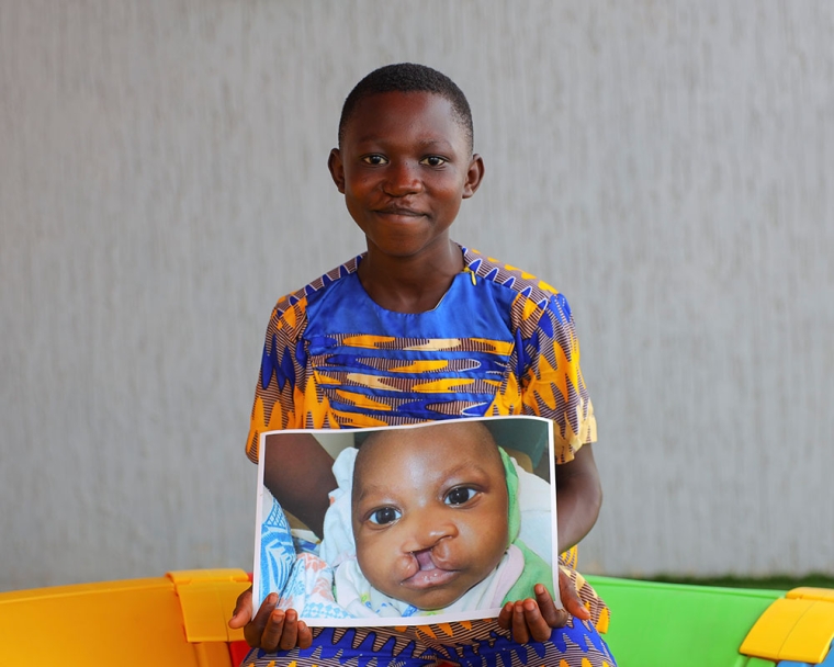 A smiling KATH patient holding a picture of himself before cleft surgery