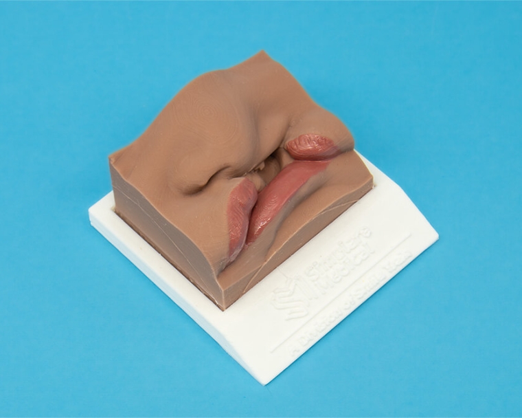 Side angle of severe marking lip